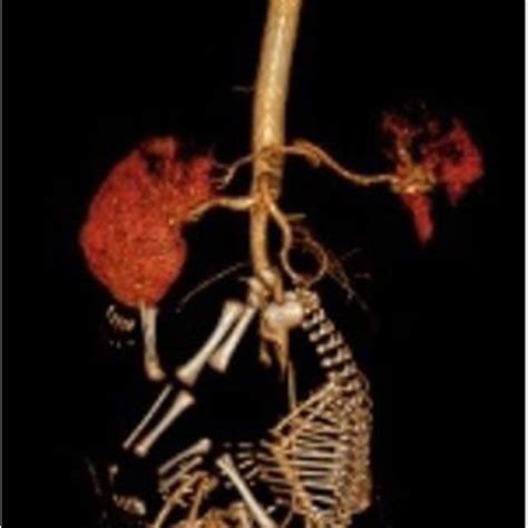 D Reconstruction Of Ct Angiography Showing Areas Of Splenic And Right