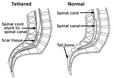 Tethered Spinal Cord Syndrome Causesymptoms Treatment