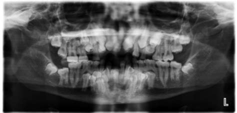 Cleidocranial Dysostosis Radiology