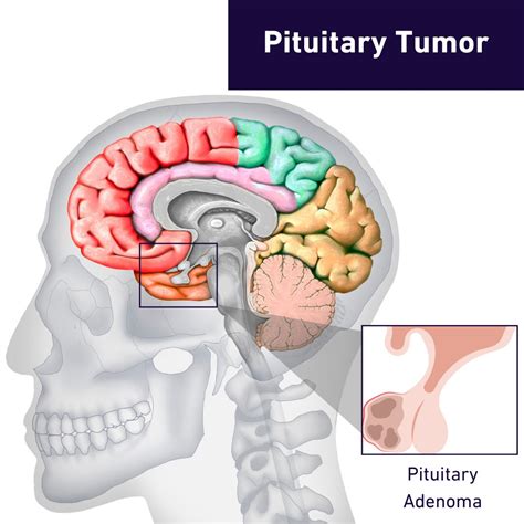 Pituitary Tumors And Adenomas Princeton Brain Spine And Orthopedics