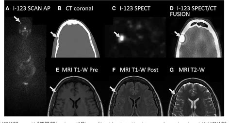 Figure 3 From False Positive Imaging For Papillary Thyroid Cancer