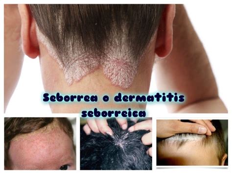 Seborrea O Dermatitis Seborreica Canal Salud Y Belleza Natural