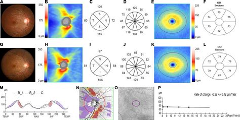 Frontiers Longitudinal Changes In Peripapillary Retinal Nerve Fiber