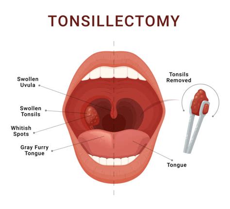 Before And After Tonsillectomy