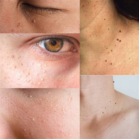 Skin Lesions Types Causes And Treatments Imago Aesthetic