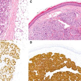 Anatomical Patterns Of Cutaneous Metastases In Male Left And Female