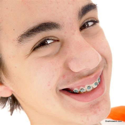 60 Photos of Teenagers with Braces - Robweigner's blog