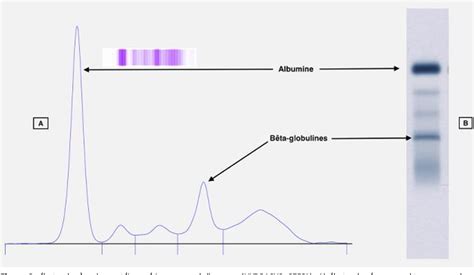 Figure 1 from Une électrophorèse des protéines sériques insolite dans