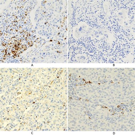 Immunohistochemical Staining For PD L1 Using The SP142 Assay A PD L1