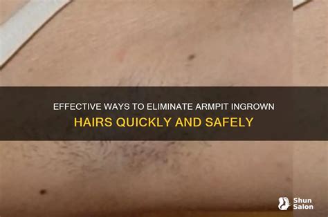 Effective Ways To Eliminate Armpit Ingrown Hairs Quickly And Safely