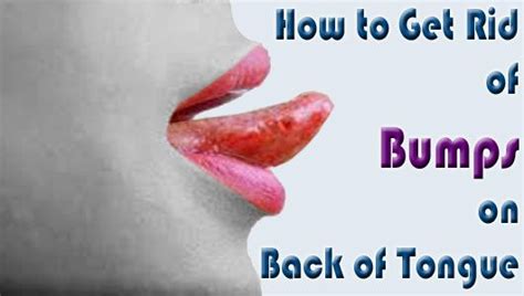 How To Get Rid Of Bumps On Back Of Tongue With Home Remedies Home