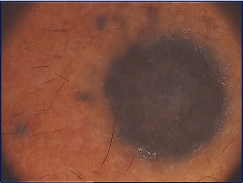 Figure 1 From Blue Nevus With Satellitosis Mimicking Melanoma