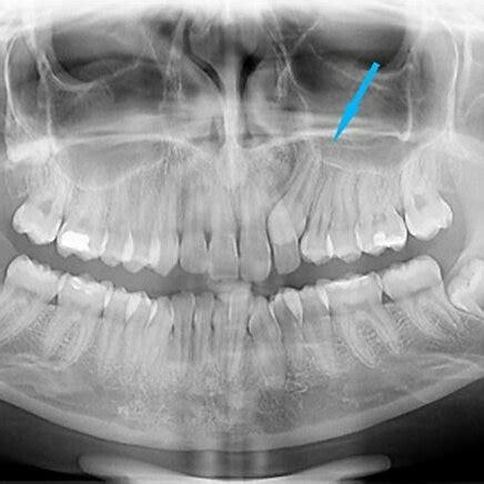 Palatal Position Of The Impacted Maxillary Canine Cusp Personal Case