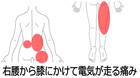 腰痛の症例「腰椎分離すべり症と診断され痛みに耐えながら生活」 南浦和の整体「巡り整体院」口コミno1で雑誌にも掲載