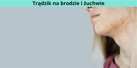 Bolace Pryszcze Pod Skora Best Sale Cpshouston Net