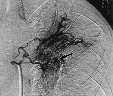 Bronchial And Nonbronchial Systemic Artery Embolization For Life