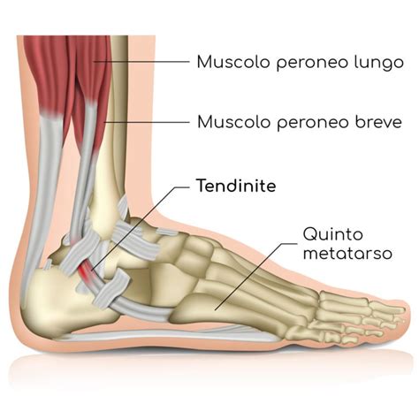Tendinite E Tendinopatie Sintomi Causa E Rimedi Valori Normali