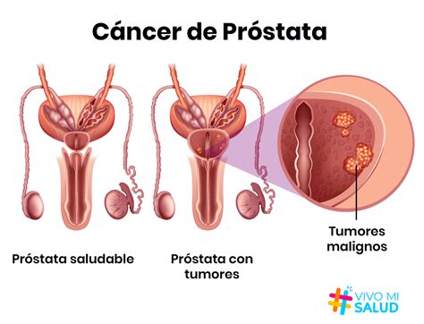 C Ncer De Pr Stata Y Sus M Ltiples Opciones De Tratamiento