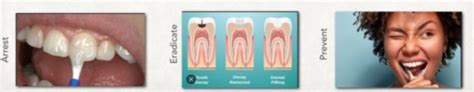 Disease Control Phase The Caries Control Protocol Flashcards Quizlet