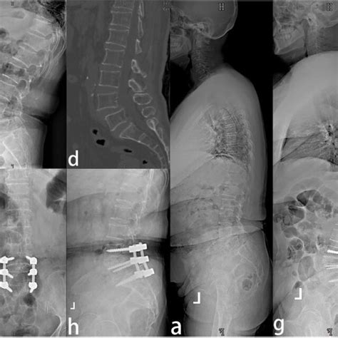 A 53 Year Old Female Patient With L4l5 Two Level Lumbar Download Scientific Diagram