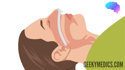 Nasopharyngeal Airway Insertion Osce Guide Laptrinhx News