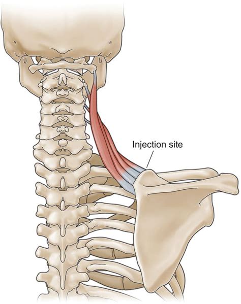 tendon injections anesthesia key