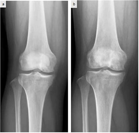 X-ray evaluation indicated that knee osteoarthritis had progressed from ...