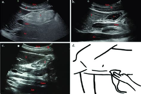 Gastric ultrasonography of an early solid stage stomach (a), fluid ...