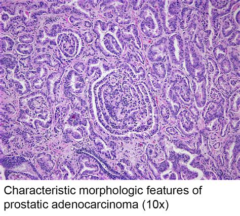 Pathology Outlines Adenocarcinoma