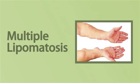 Multiple Lipomatosis