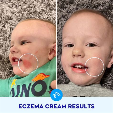 Best Eczema Cream for Kids: 5 Things to Look For