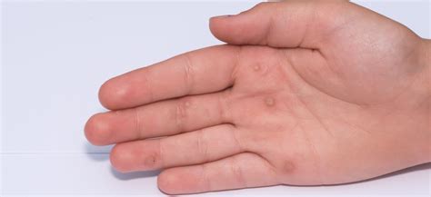 Common warts - Symptoms, Causes, Diagnosis and Treatment - MedPark Hospital