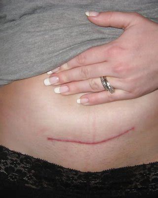 Horny Wifes With C Section Scars Porn Pictures XXX Photos Sex Images 1764854 PICTOA