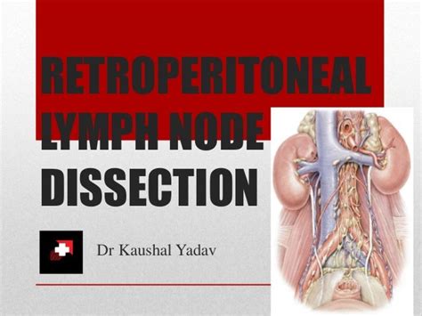 Retroperitoneal Lymph Nodes Anatomy - Anatomy Reading Source