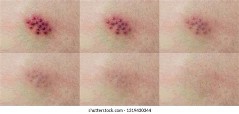 Virus On Body Rash Shingles On Stock Photo 1319430344 | Shutterstock