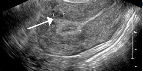 Uterine Fibroids Ultrasound