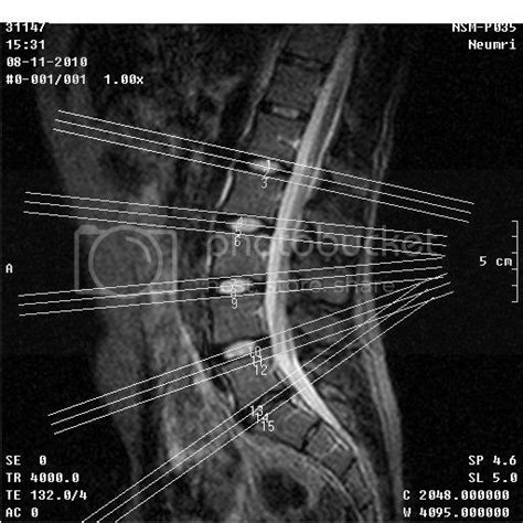 r@diOlogY dE aruN: MRI LUMBAR SPINE