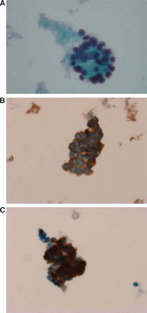 Figure 1 From Immunocytochemistry With Cytokeratin 19 And Anti Human