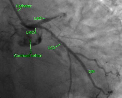 LAD total occlusion – coronary angiogram – All About Cardiovascular ...