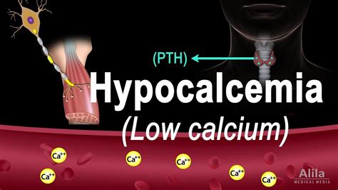 Hypocalcemia Low Calcium Pathology Causes Symptoms And Treatment Animation Youtube