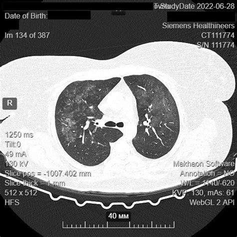 CT scan of the patient with COVID-19 infection in anamnesis, the scan... | Download Scientific ...