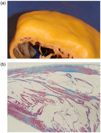 Gross Pathologic Specimen A Of Patient 1 Demonstrating The Fibrofatty