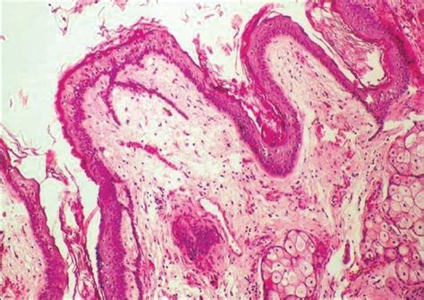 Photomicrograph Of The Excised Mass Revealing A Typical Dermoid Cyst