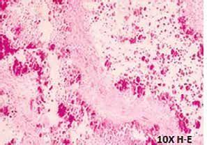 Hyperphosphatemic Tumoral Calcinosis Case Presentation And Clinical