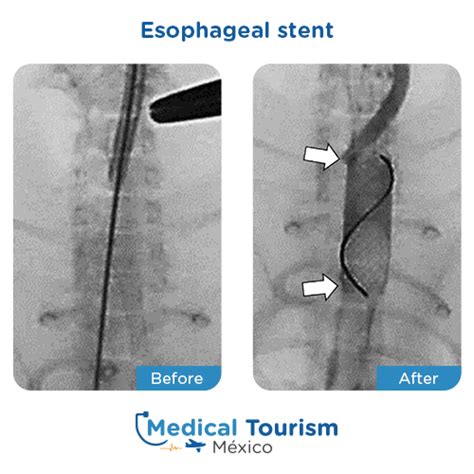 Best Surgeons For Esophageal Stent In Mexico Medical Tourism Mexico