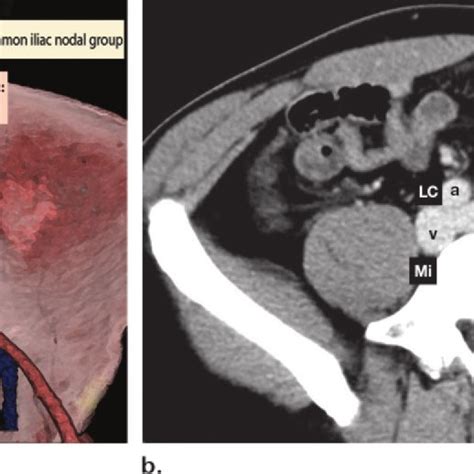 External iliac lymph node group. Illustration (a) and axial ...