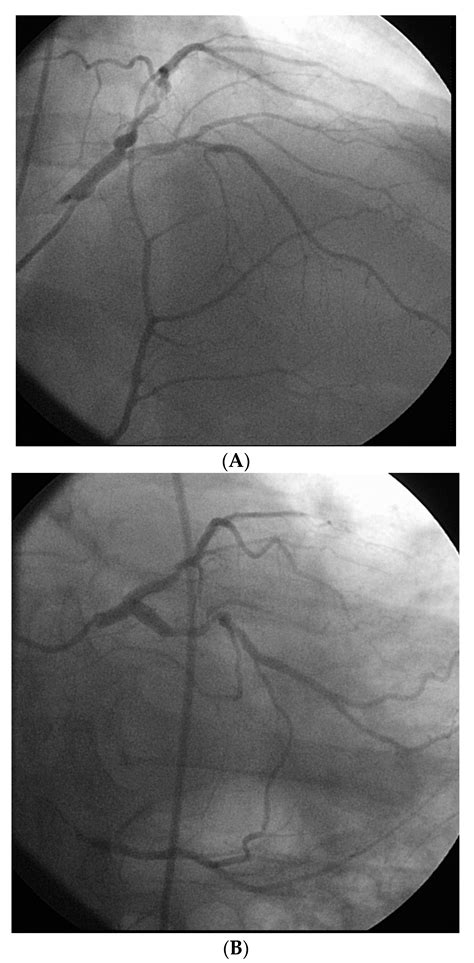 Jcm Free Full Text Robotic Assisted Percutaneous Coronary