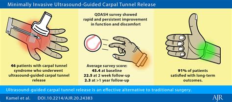 Minimally Invasive Ultrasound Guided Carpal Tunnel Release Improves Long Term Outcomes