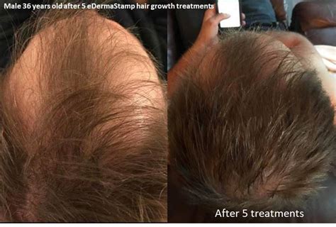 Hair And Scalp Treatment Dermaroller® Micro Needling Collagen