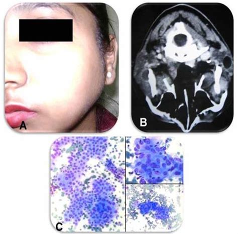 Parotid Gland Tuberculosis Presentation Of 4 Case Variants Semantic